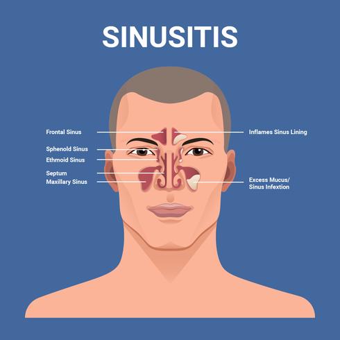 Ilustración de vector de sinusitis