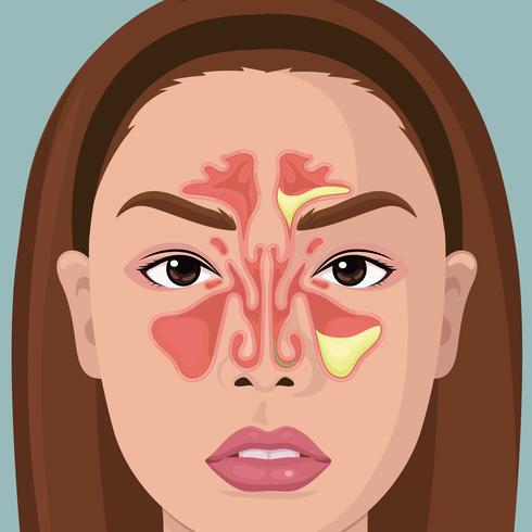 Woman With Illustration Of Paranasal Sinus vector