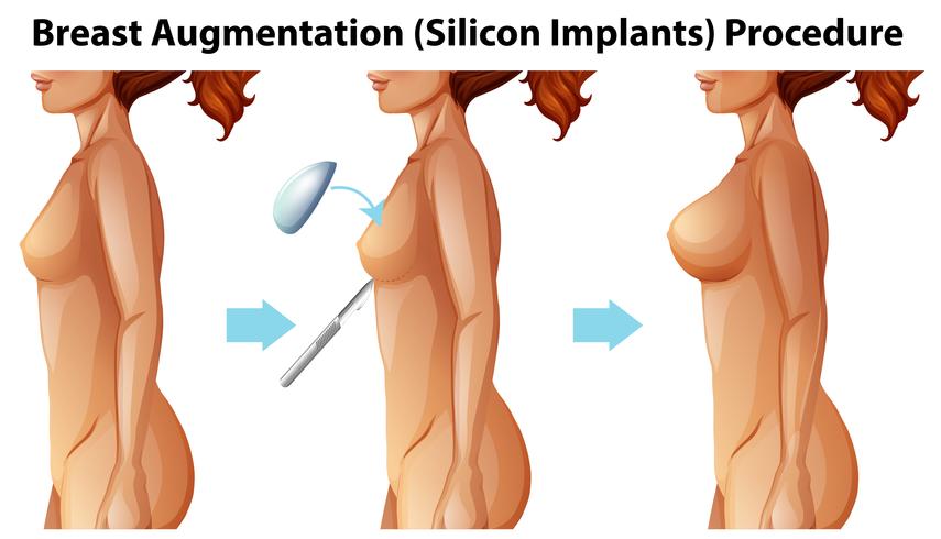 Un vector de implantes mamarios femeninos