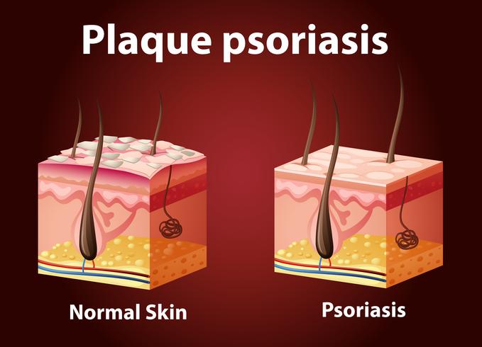 Diagram showing plaque psoriasis vector