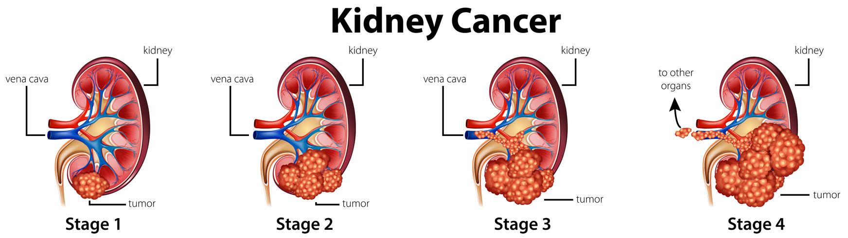 Diagrama que muestra las diferentes etapas del cáncer de riñón. vector