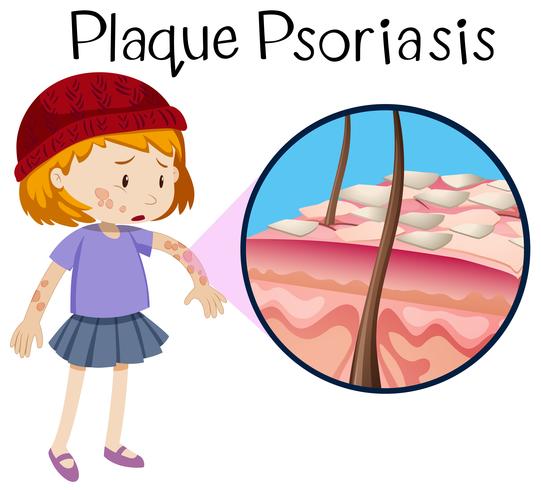 Human Anatomy of Plaque Psoriasis vector