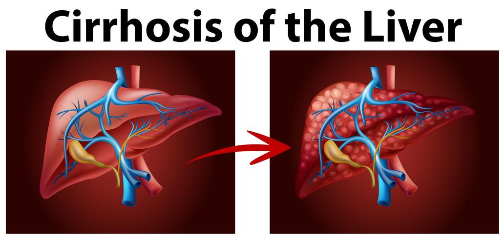 Diagrama que muestra la cirrosis del hígado. vector