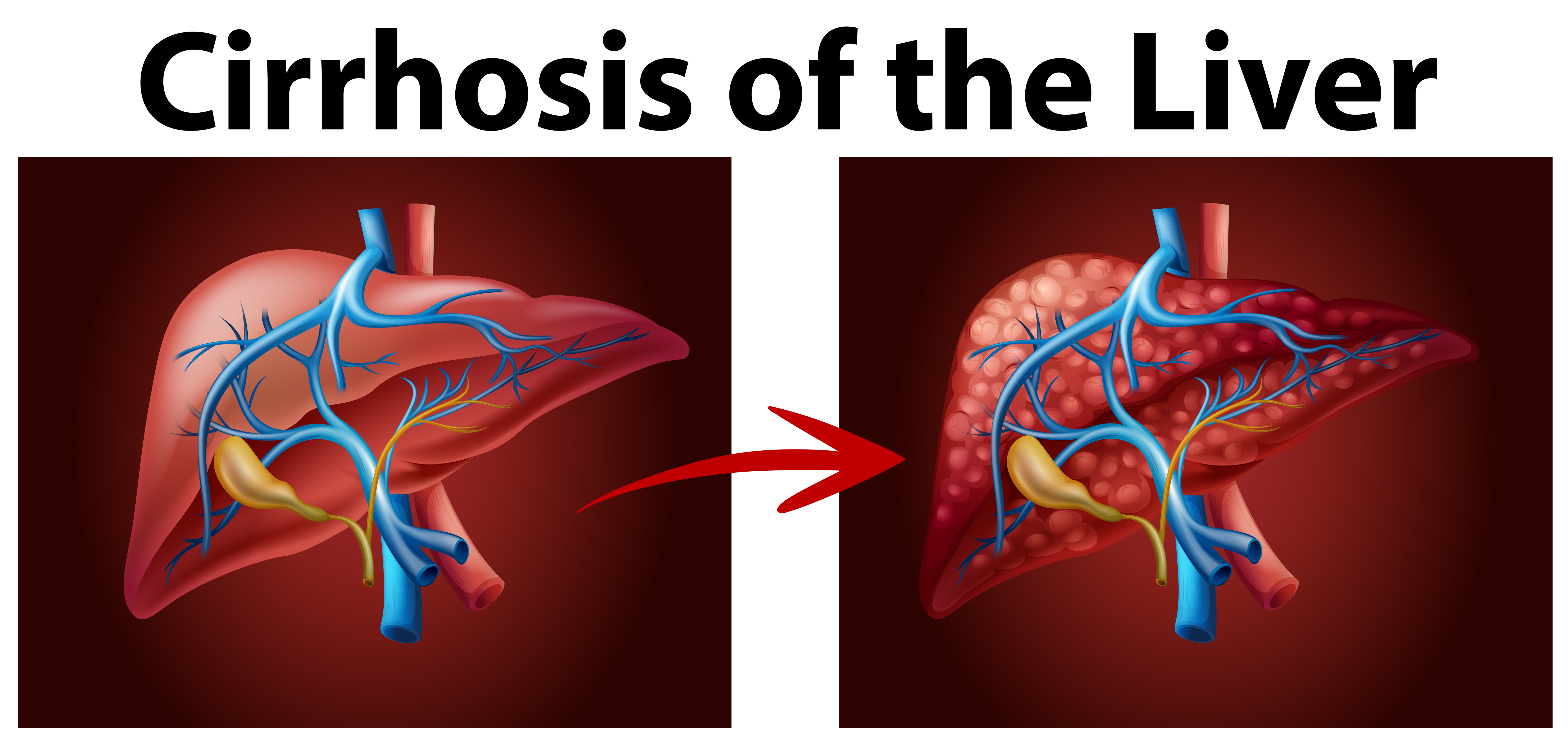 Diagram showing cirrhosis of the liver 292464 - Download Free Vectors, Clipart Graphics & Vector Art