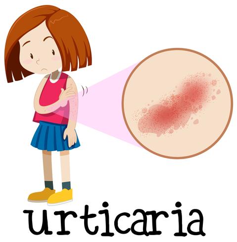 A Young Girl Having Urticaria vector