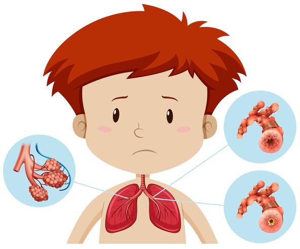 Un niño con bronquitis vector