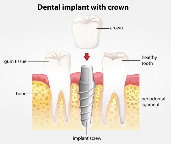 Dental implant with crown vector
