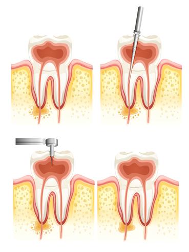 Endodoncia dental vector