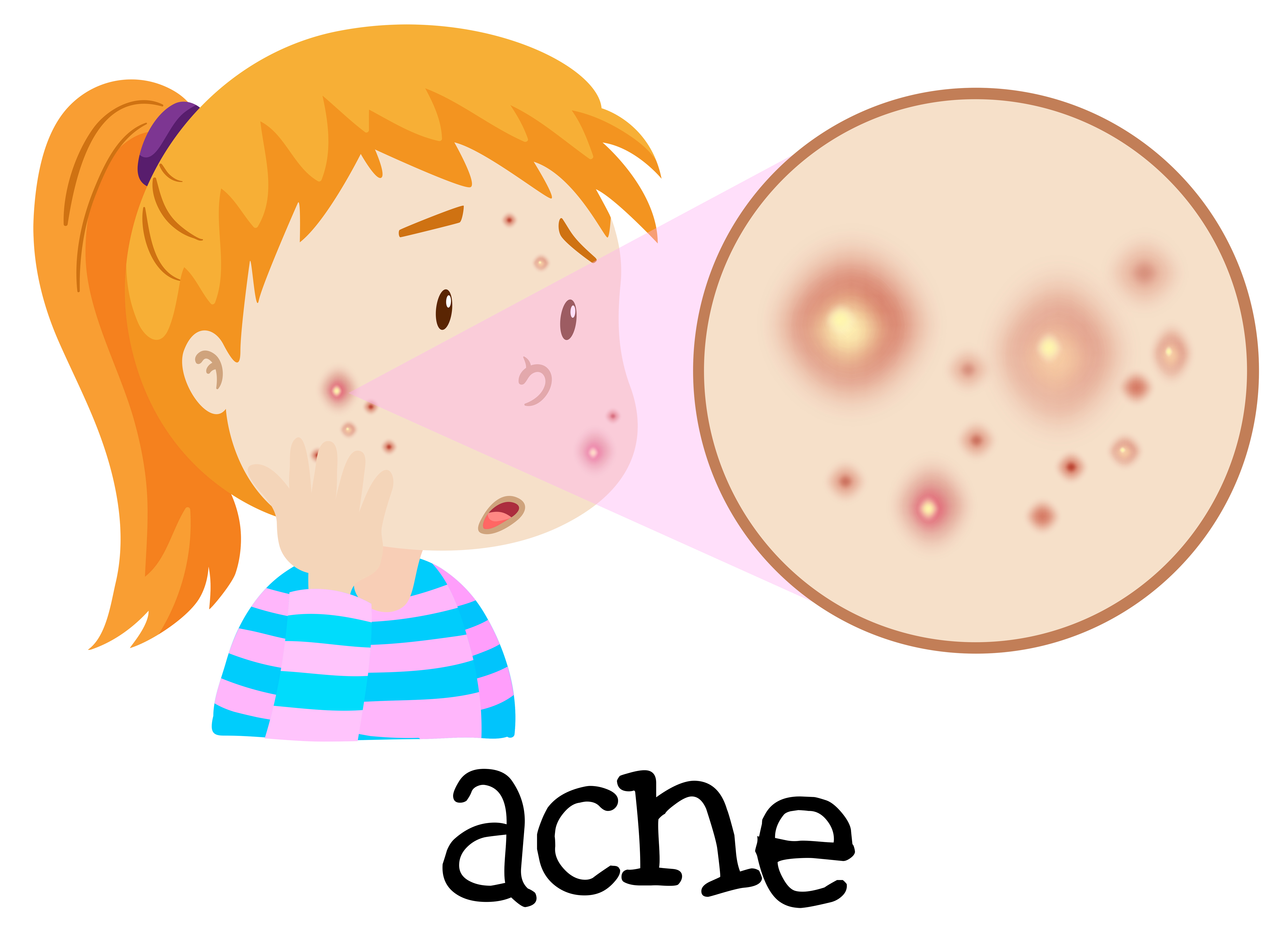 A Young Woman Having Acne  Download Free Vectors Clipart 