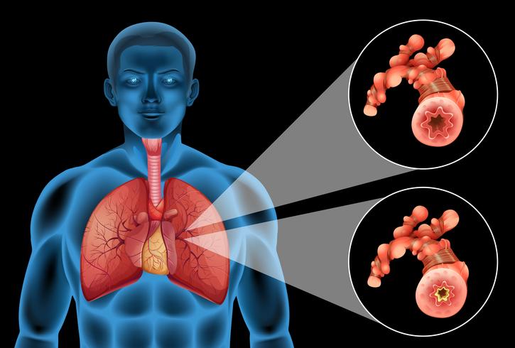 Diagram showing human lungs and disease vector