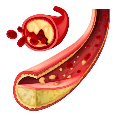 Blood with fat in vessel  vector