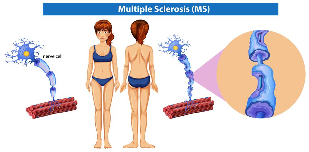 Una anatomía humana de la esclerosis múltiple vector