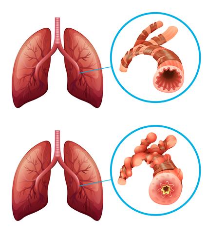 Diagrama que muestra los pulmones con enfermedad. vector