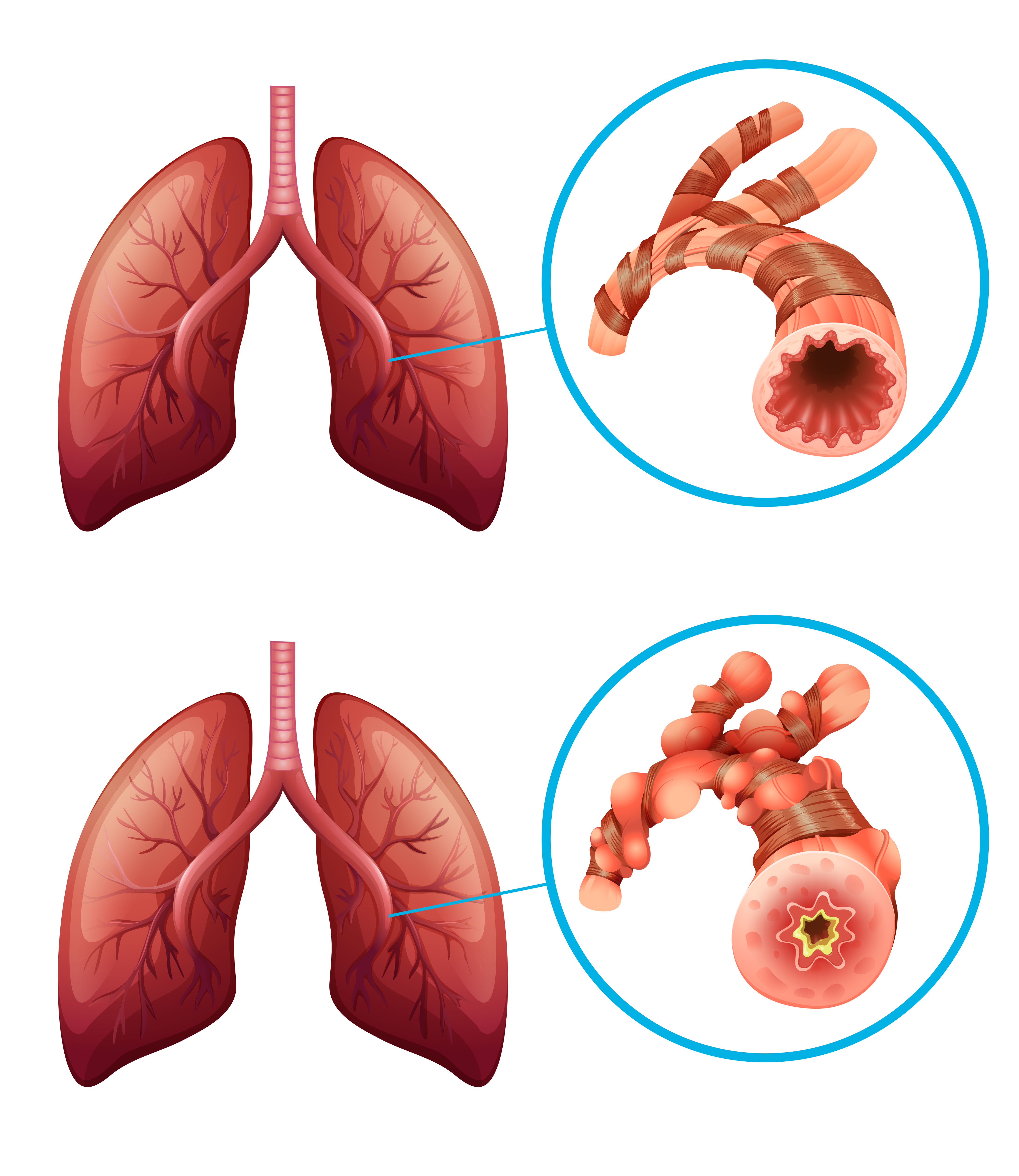 Diagram Showing Lungs With Disease