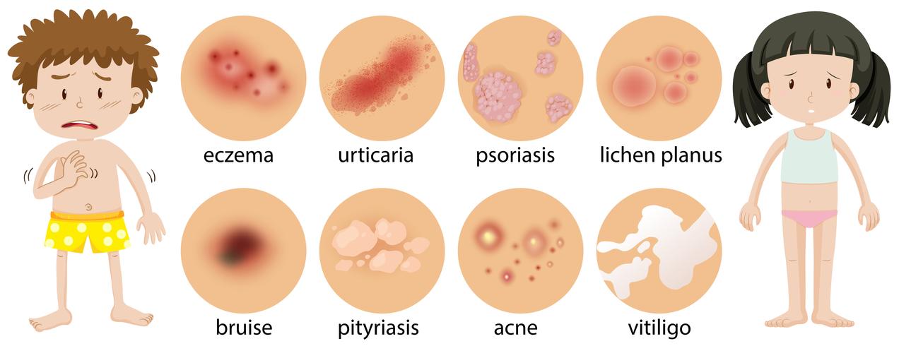 Young children with different skin conditions vector