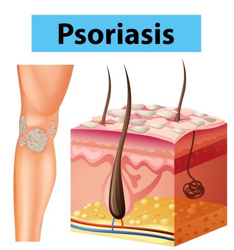 Diagrama que muestra la psoriasis en la piel humana. vector