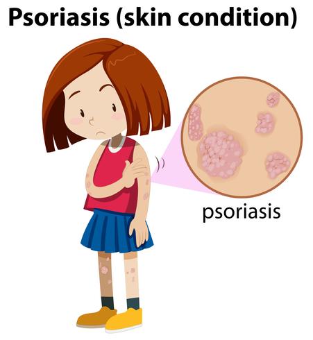 Chica joven con psoriasis magnificada vector