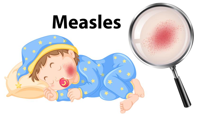 A Vector of Measles on Baby Face