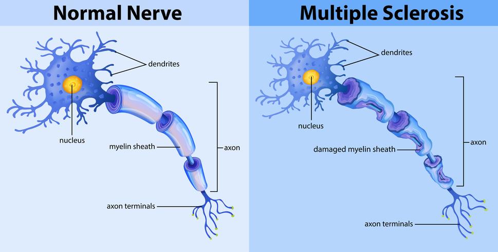 Nervio normal y esclerosis múltiple vector