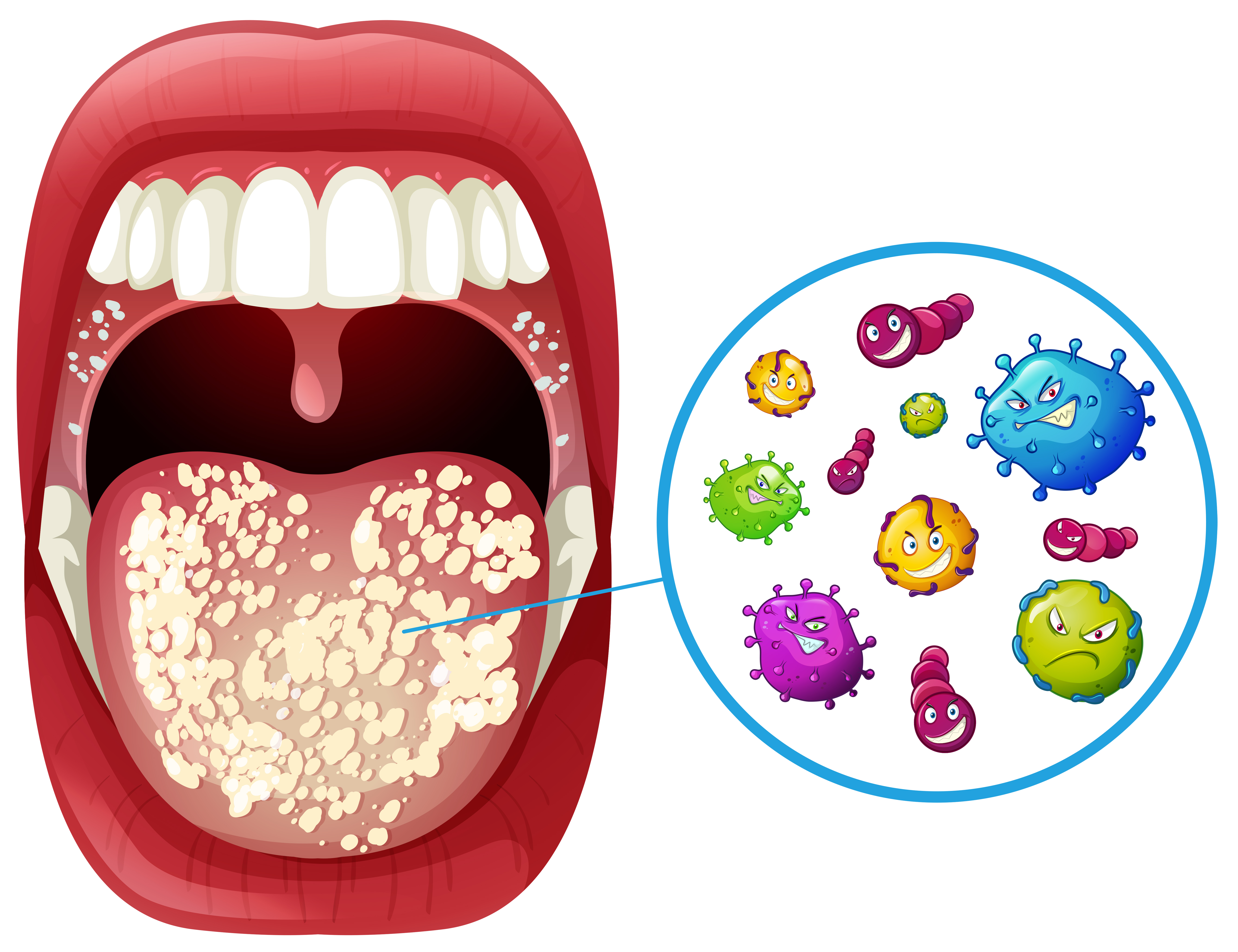 https://static.vecteezy.com/system/resources/previews/000/294/130/original/vector-a-human-mouth-virus-infection.jpg