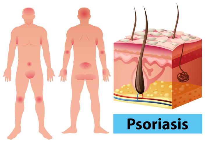 Diagram showing psoriasis in human vector