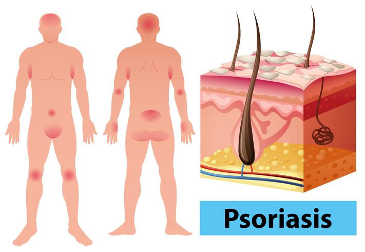 Diagrama que muestra la psoriasis en humanos vector