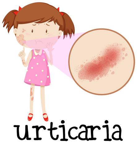 Young girl with urticaria vector