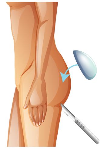 A Vector of Buttock Augmentation