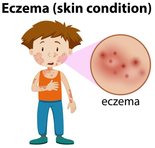 eczema magnificado en chico joven vector