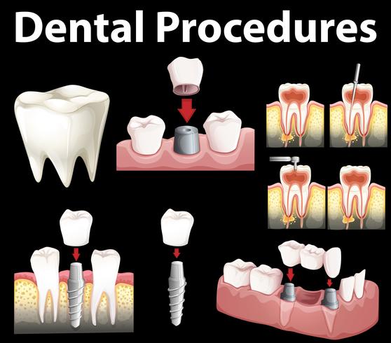 Procedimientos dentales de hacer dientes falsos. vector