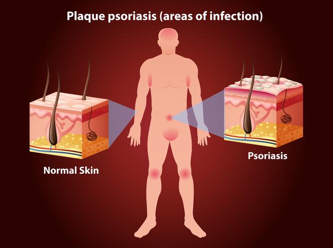 Diagram showing plaque psoriasis in human vector