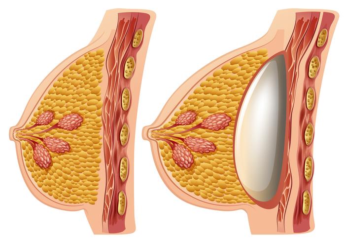 Un vector de implantes mamarios femeninos