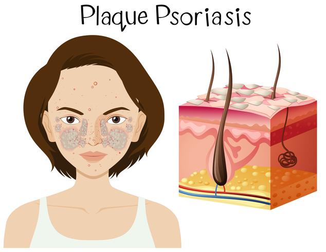 Anatomía humana de la psoriasis en placa vector