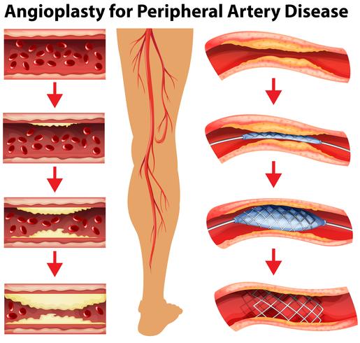 Diagram showing angioplasty for peripheral artery disease vector