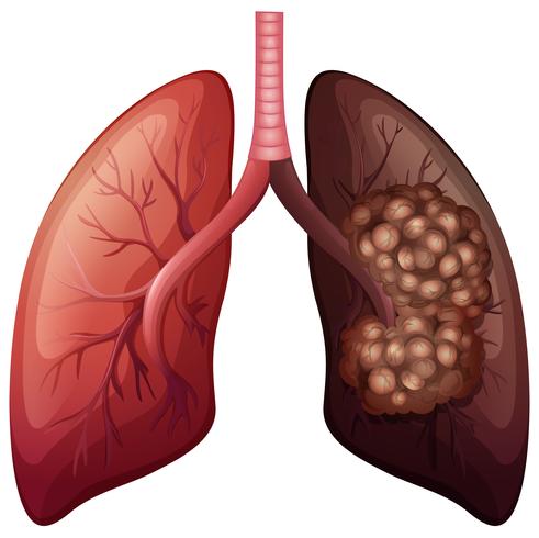 Pulmón normal y cáncer de pulmón. vector