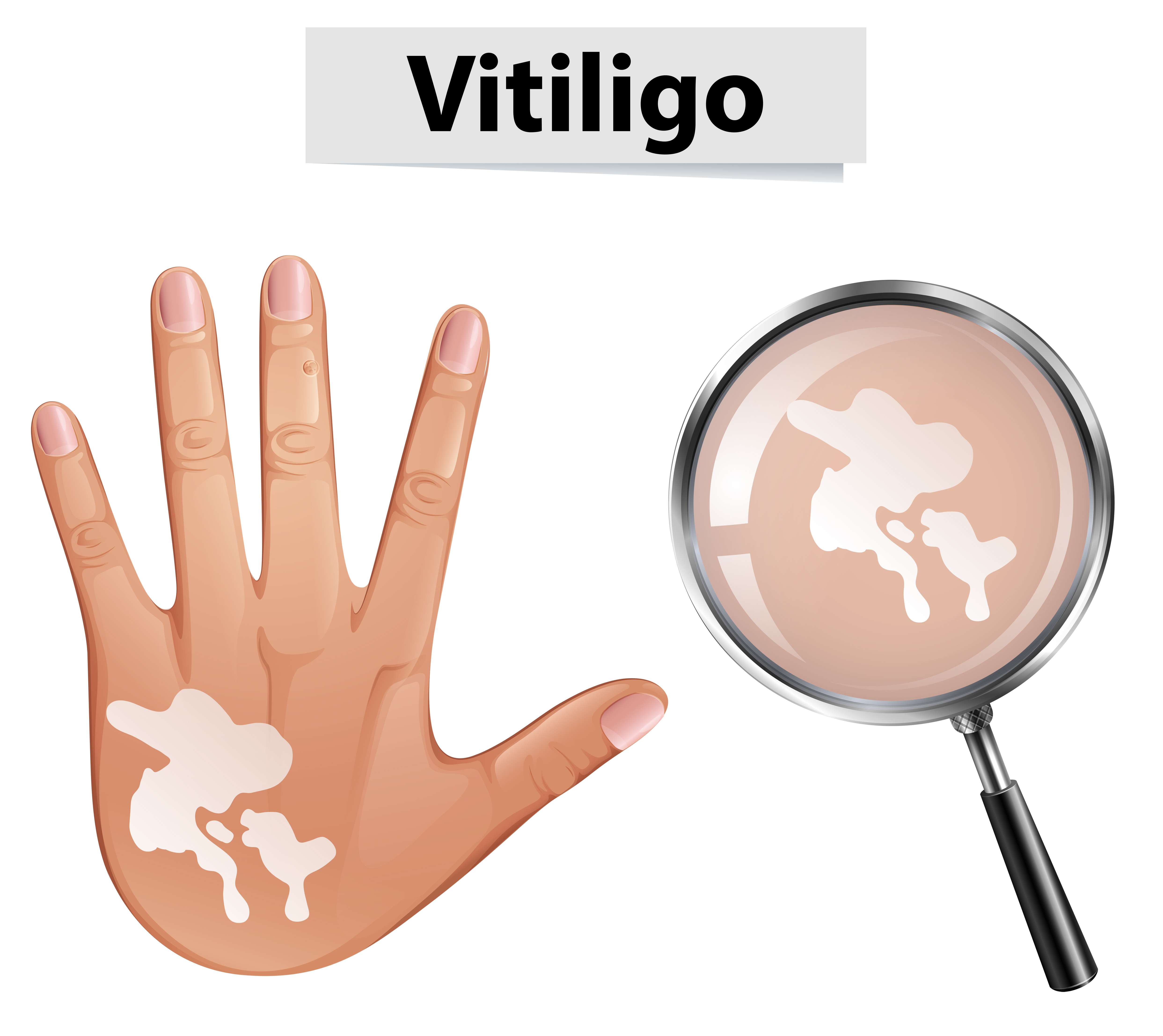 Vitiligo Vector Art Icons And Graphics For Free Download Vitiligo Vector Art Icons And Graphics For Free Download