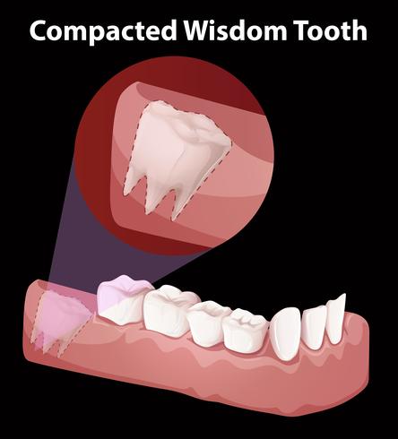 Compacted Wisdom Tooth Diagram vector