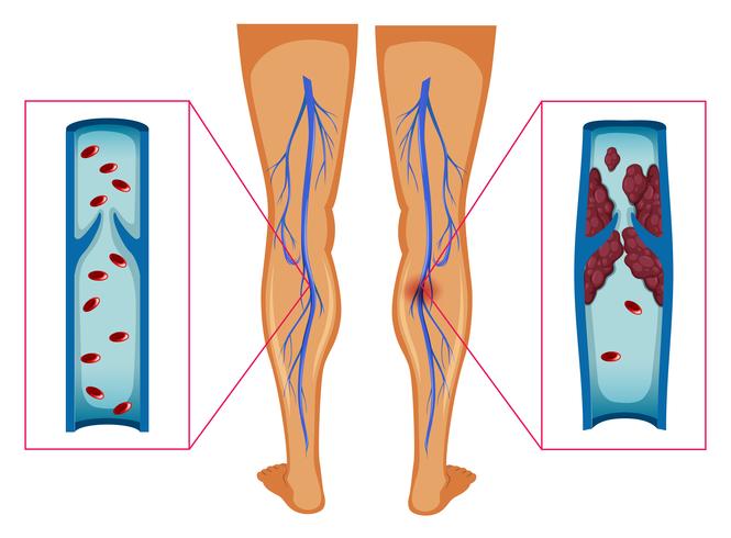 Diagrama que muestra el coágulo de sangre en las piernas humanas vector