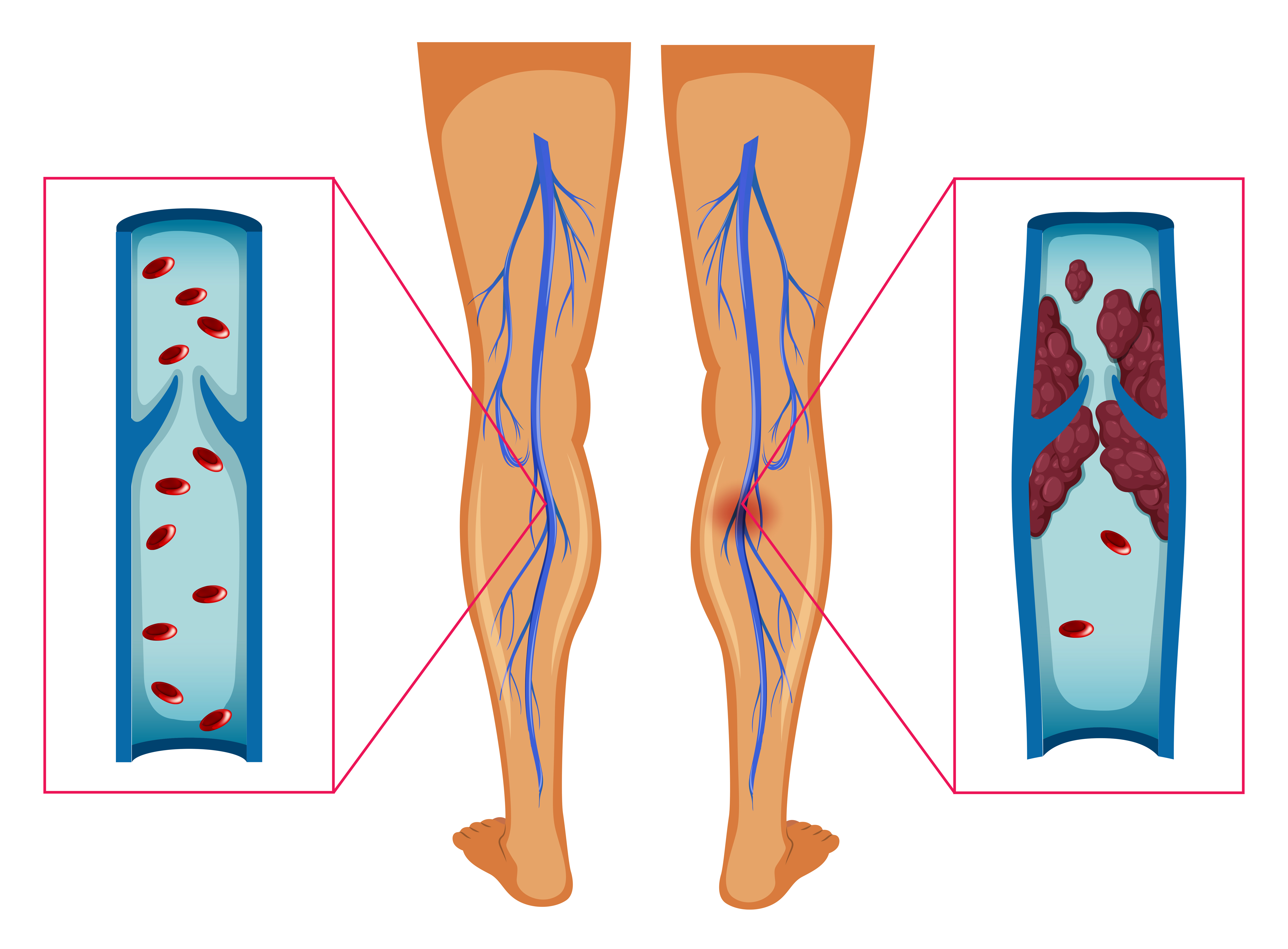 do blood clots travel down the leg