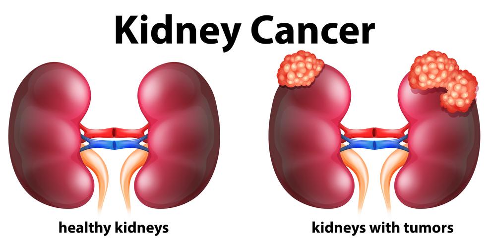 Diagrama que muestra el cáncer de riñón en humanos vector