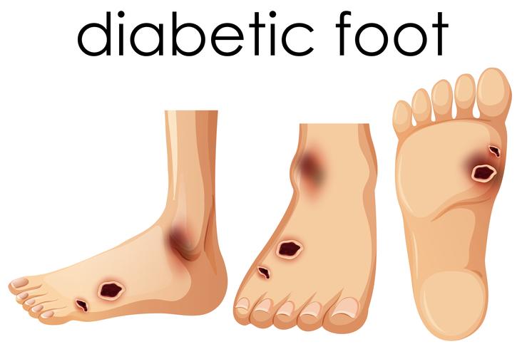 Human Foot with Diabetic  vector