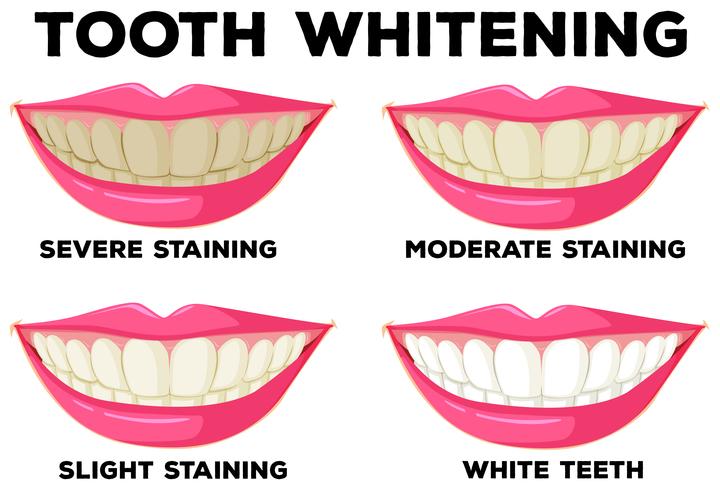 Proceso de blanqueamiento dental. vector