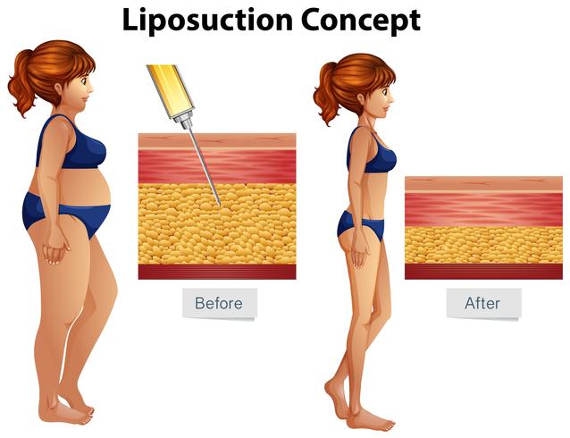 Diagrama del concepto de liposucción humana vector