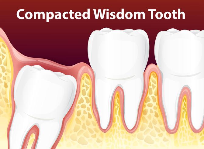 Compacted Wisdom Diagram Tooth vector