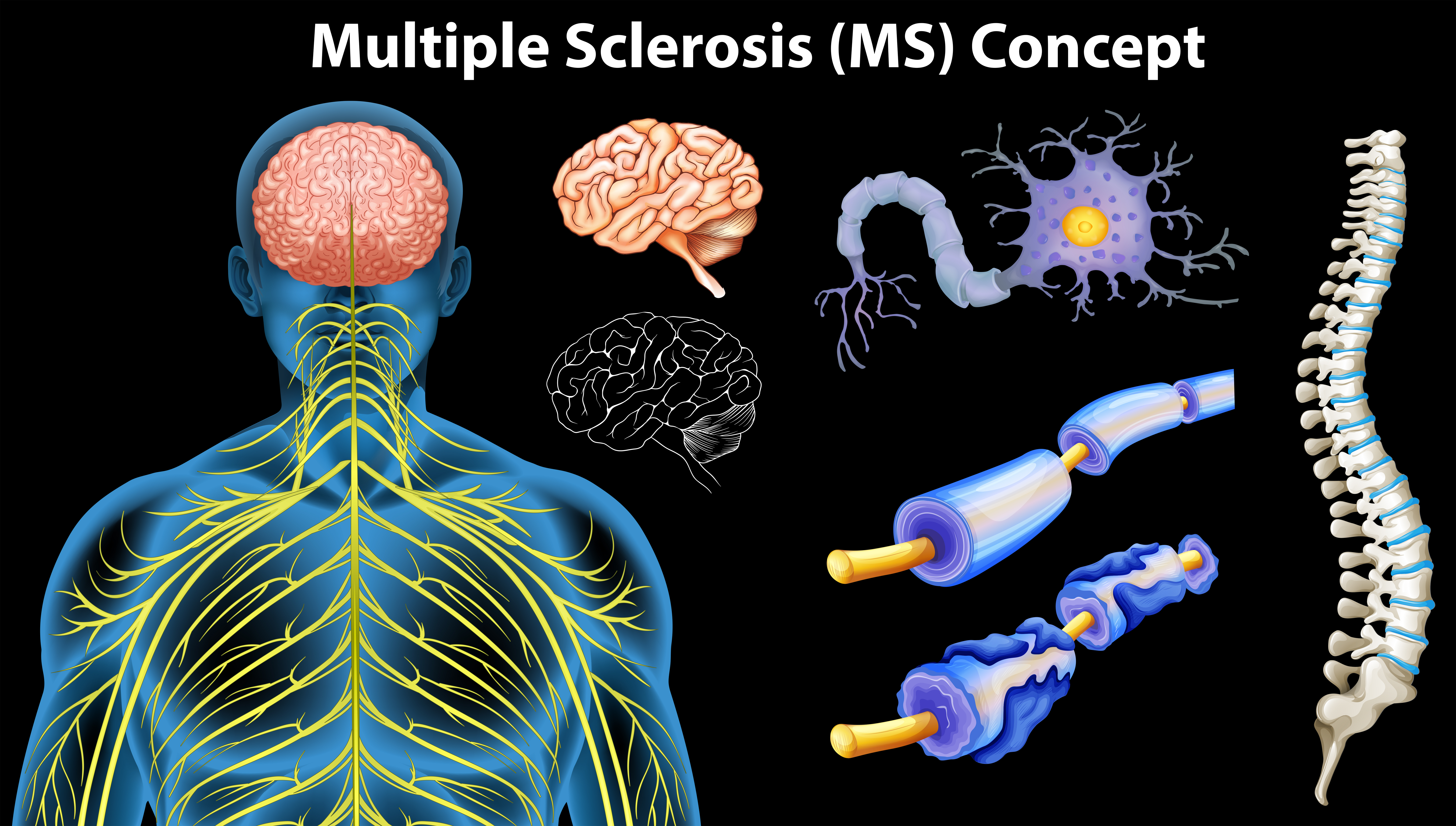 Dieta esclerosis multiple