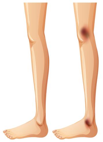 Las piernas humanas y moretones sobre fondo blanco vector