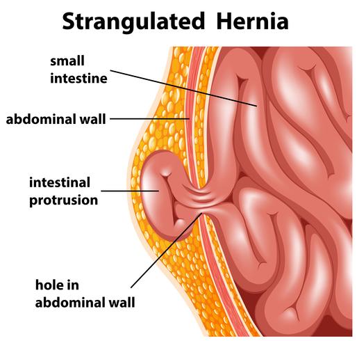 Strangulated Hernia vector