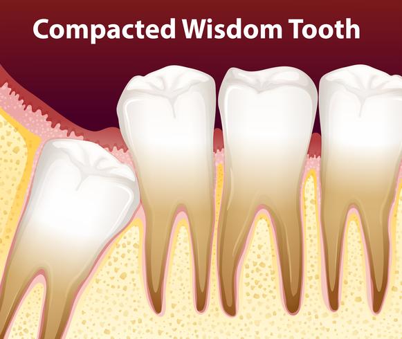 A Compacted wisdom tooth  vector