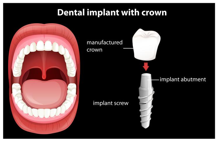 Vector medico de implante dental