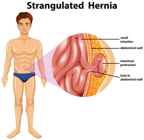 Anatomía humana de la hernia estrangulada vector